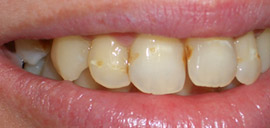 Before Implant Crown
